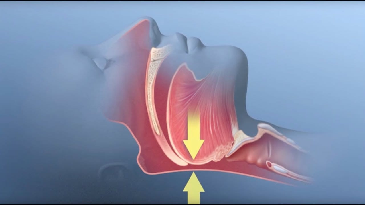 obstructive-sleep-apnea-osa-symptoms-treatment